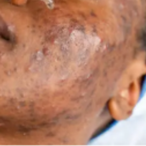 Acne/Pimples